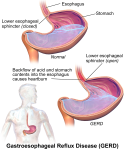 Image depicting the difference between and functioning lower esophageal sphincter and one that is not working resulting in GERD