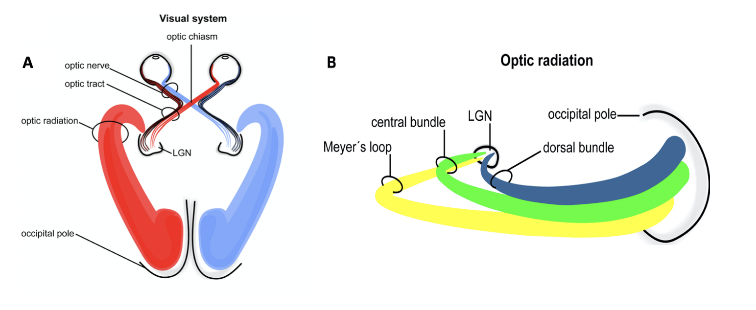 Figure A shows a simplified diagram of the visual system, emphasizing optic radiation from the LGN. Figure B shows another diagram of optic radiation, demonstrating the dorsal bundle, central bundle, and Meyer's loop radiating out from the LGN.